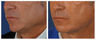 Before & After Liquid Necklift