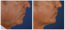 Before & After Liquid Necklift