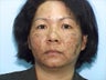 Skin Treatment Using Obagi NuDerm System