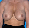 Breast Revision