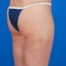 Cellulaze Before and After