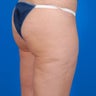 Cellulaze Before and After