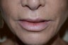 Before and After Upper Lip Lift