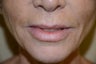 Before and After Upper Lip Lift