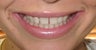 Invisalign For Spacing