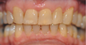 Removing a horrid front tooth after 35 years with Invisalign