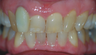 Removing a horrid front tooth after 35 years with Invisalign