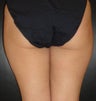 SmartLipo MPX