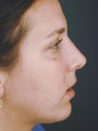 Female Chin Implant