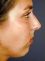 Female Chin Implant