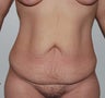 Massive Weight Loss