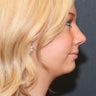 Chin Implant