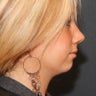 Chin Implant