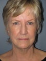 LiteLift™, Brow Lift, Fat Transfer Liposuction Under Chin on 68-year-old Woman