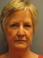 LiteLift™, Brow Lift, Fat Transfer Liposuction Under Chin on 68-year-old Woman