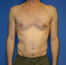 Pectoral Augmentation Surgery