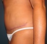 Tummy Tuck