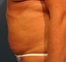 Tummy Tuck
