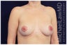 Breast lift