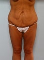 Body Lift