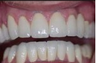 Full Mouth Restoration