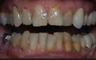 Full Mouth Restoration