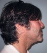 Neck lift in 46 year old man