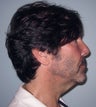 Neck lift in 46 year old man