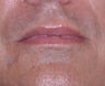 35 Year Old Male Who Desired Larger Lips
