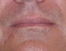 35 Year Old Male Who Desired Larger Lips