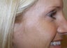 Botox to the Crow's Foot Area