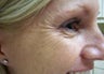 Botox to the Crow's Foot Area