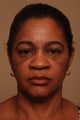 Rhinoplasty