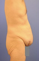 Body Lift