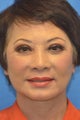 Asian Female Treated with Buccal Fat Removal
