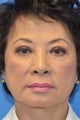 Asian Female Treated with Buccal Fat Removal