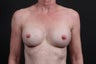 51 year old female that underwent breast pocket repair, capsule removal, and implant exchange