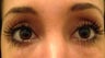 PeriOrbital Facial Filler 28 years old