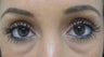 PeriOrbital Facial Filler 28 years old