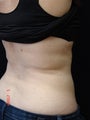 Coolsculpting