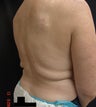 Coolsculpting
