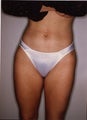 Tumescent Liposuction