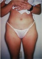 Tumescent Liposuction