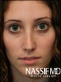 Female Primary Rhinoplasty