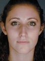 Female Primary Rhinoplasty