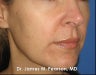 Melasma Treatment