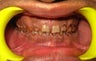Full Mouth Rehabilitation with Zirconia Crowns