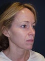 45 Year Old Female with Eyelid Surgery, Facial Implants and Signature Lift