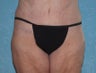 Circumferential Body Lift with Liposuction to Upper/Outer Abdomen