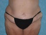 Circumferential Body Lift with Liposuction to Upper/Outer Abdomen